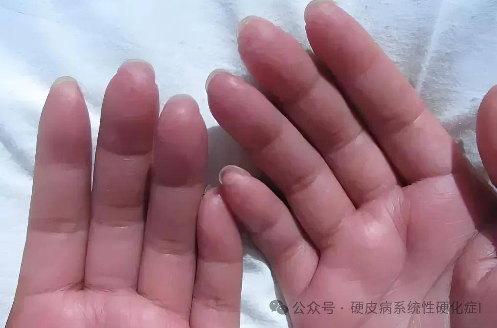 水肿期是硬皮病的早期阶段,主要表现为皮肤的非凹陷性或可凹陷性水肿