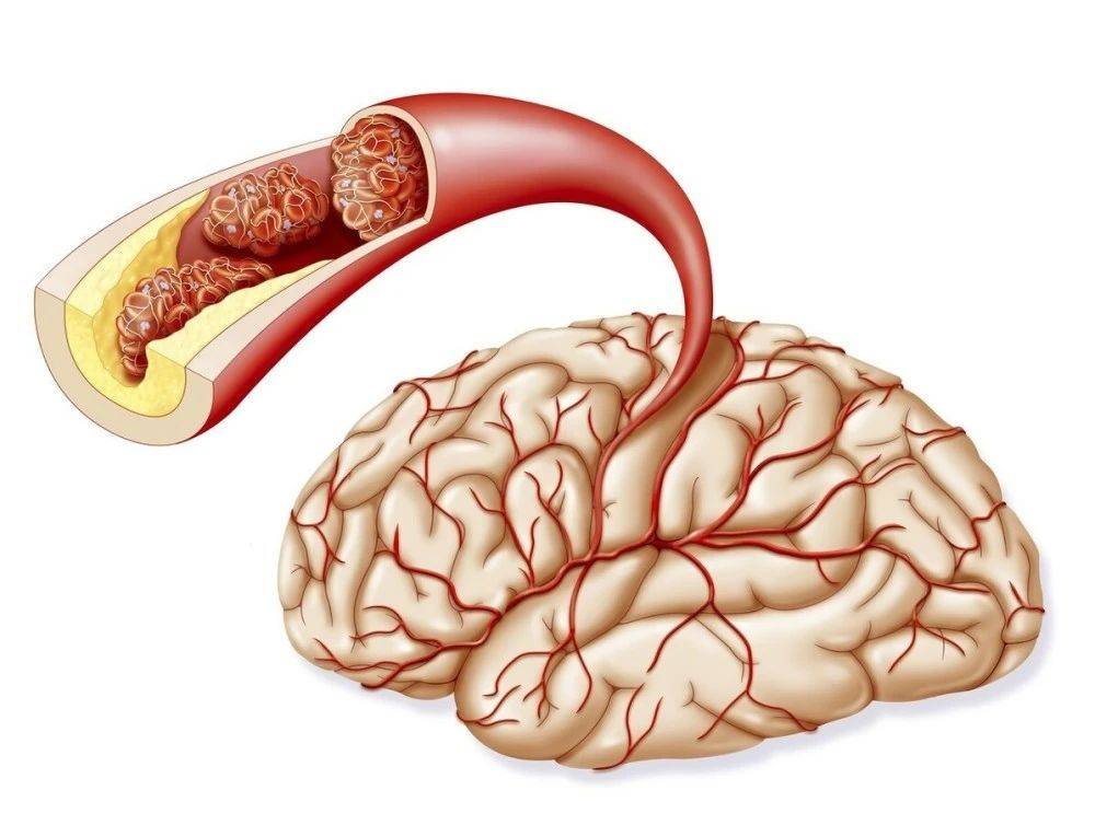 年轻人脑梗图片