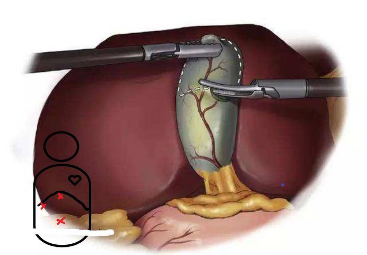 切除胆囊的明星图片