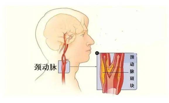 颊动脉位置图片图片