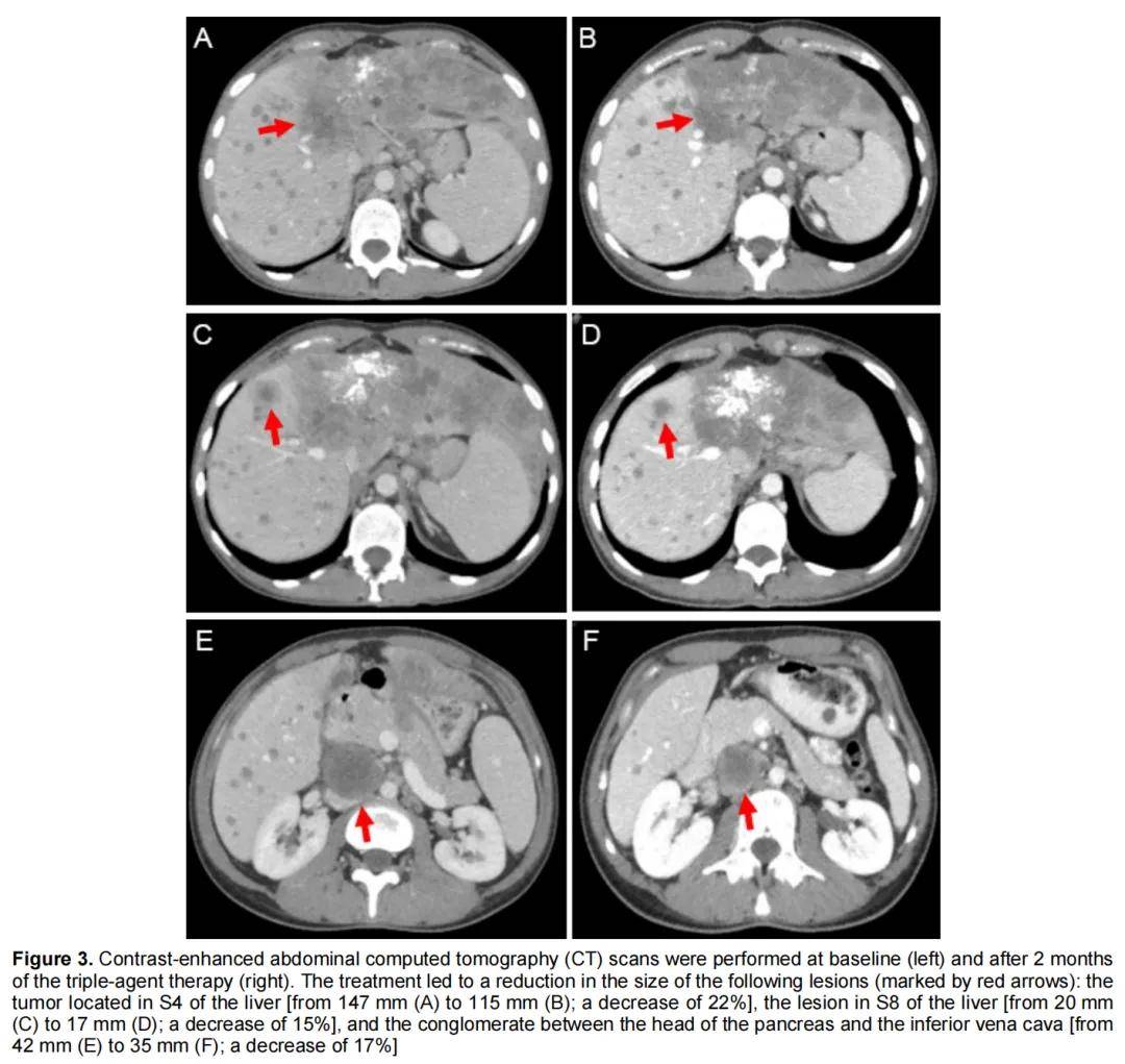 nras突变转移性肝内胆管癌获益曲美替尼联合羟氯喹和贝伐珠单抗,os达