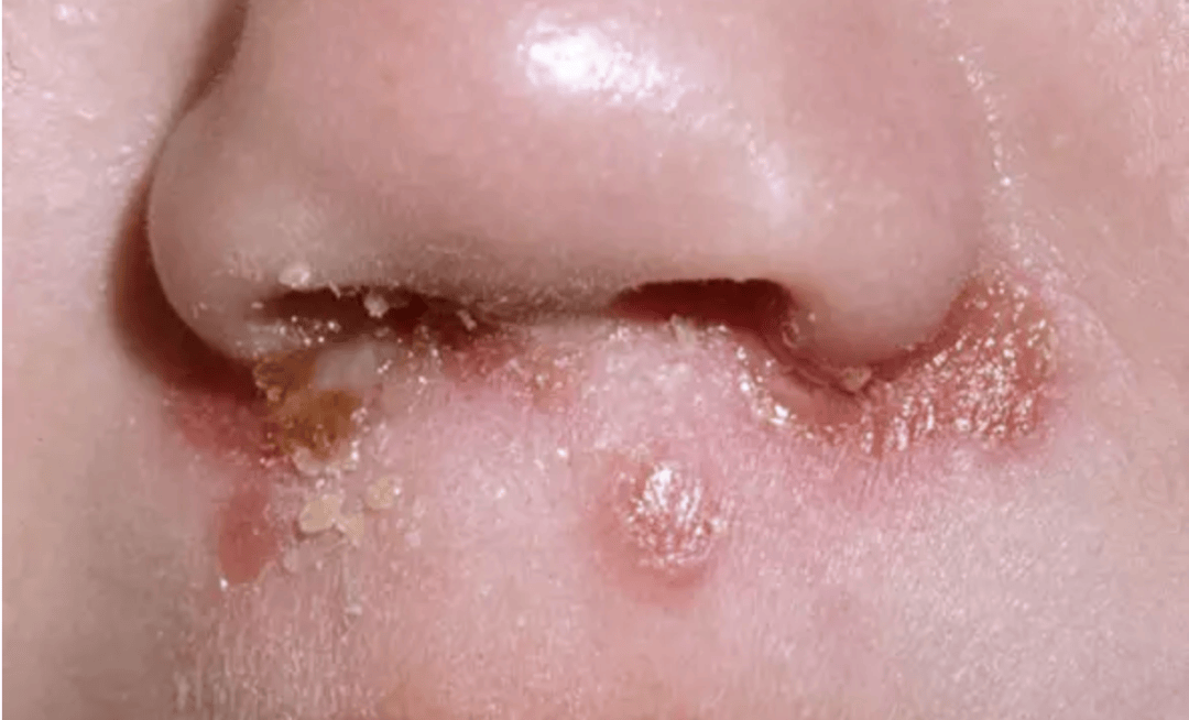 脓疱疮的成因与症状 脓疱疮严重吗 脓疱疮如何治疗