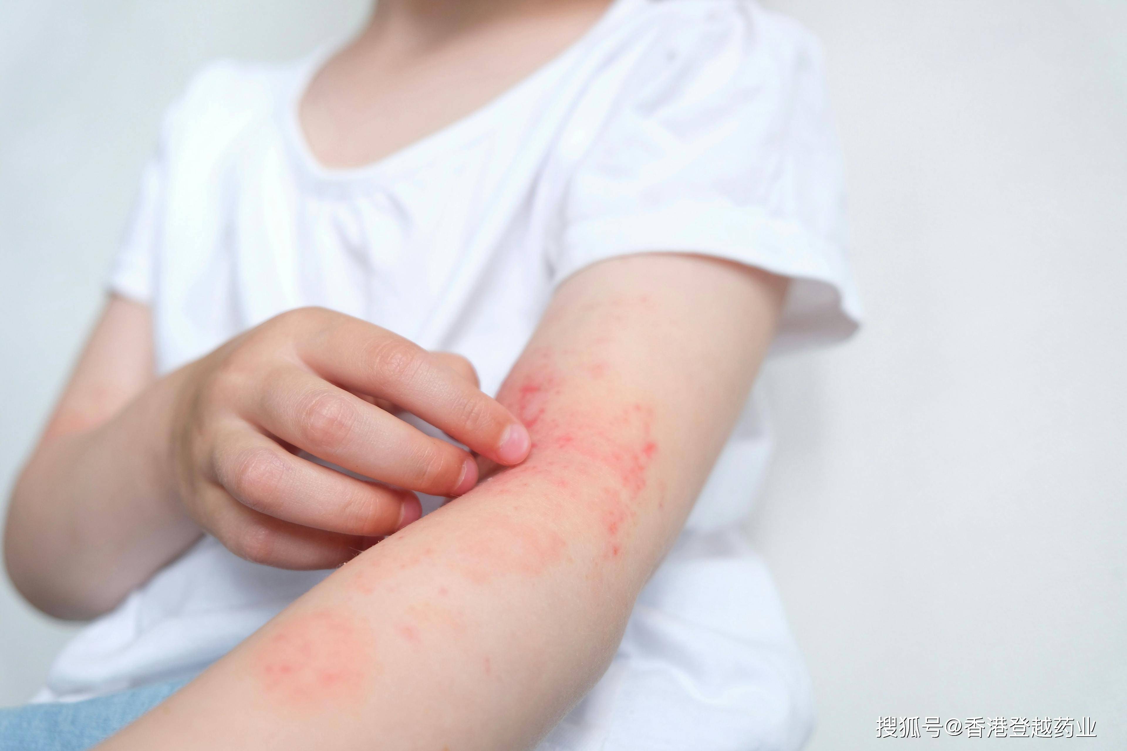 05% 罗氟司特乳膏 (zoryve) 对特应性皮炎儿童具有持久的安全性和有效