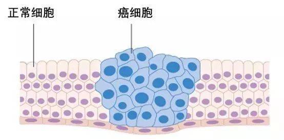 癌图片与正常图片图片