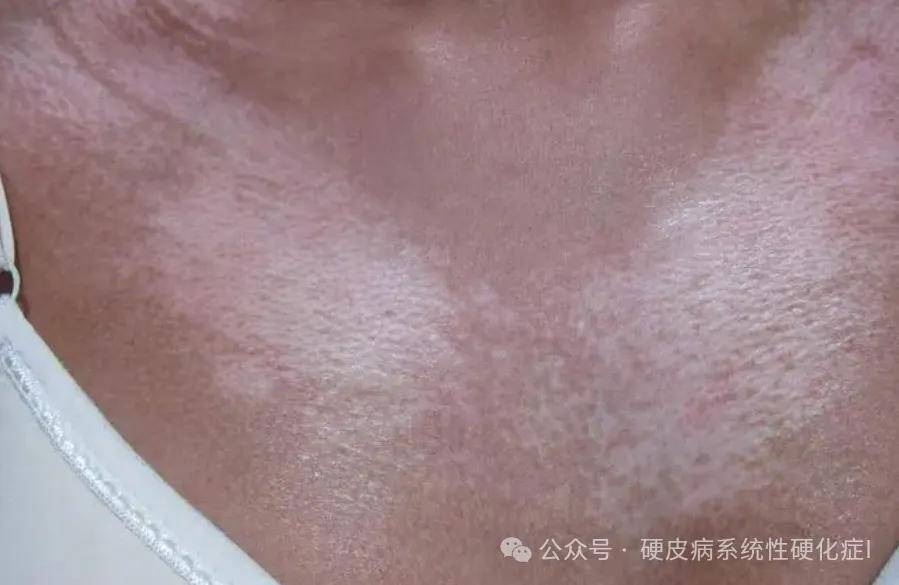 手指变色，皮肤变硬：揭开系统性硬化症的神秘面纱_手机搜狐网