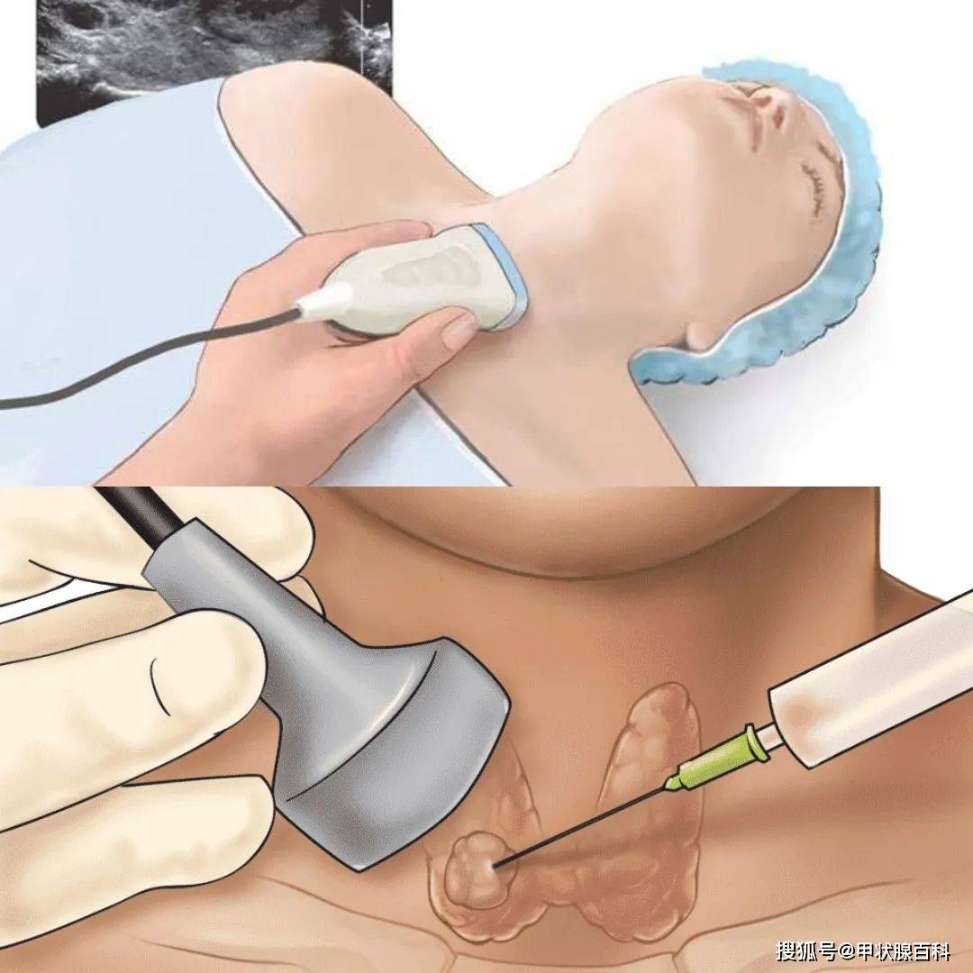 ②保留甲状腺功能消融术仅针对结