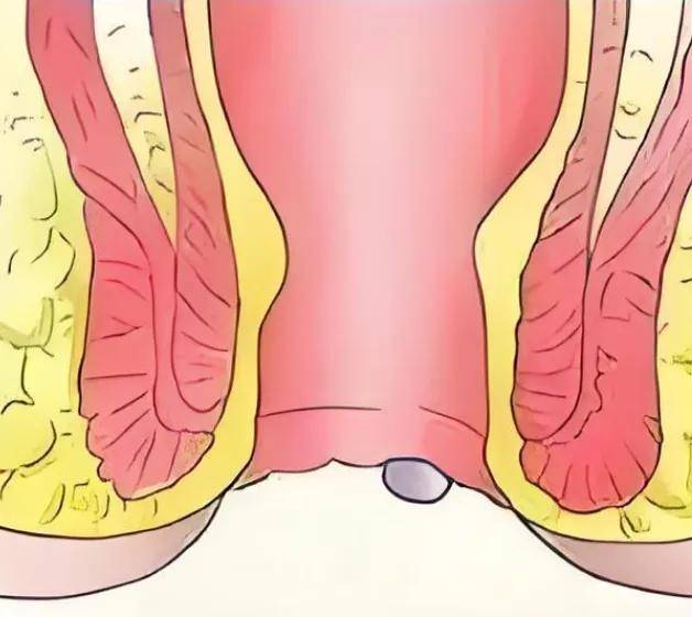 为什么肛门口会长肉疙瘩?可能是这几种疾病