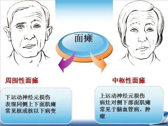 口眼歪斜是什么病?可以使用生命海洋治疗仪吗?