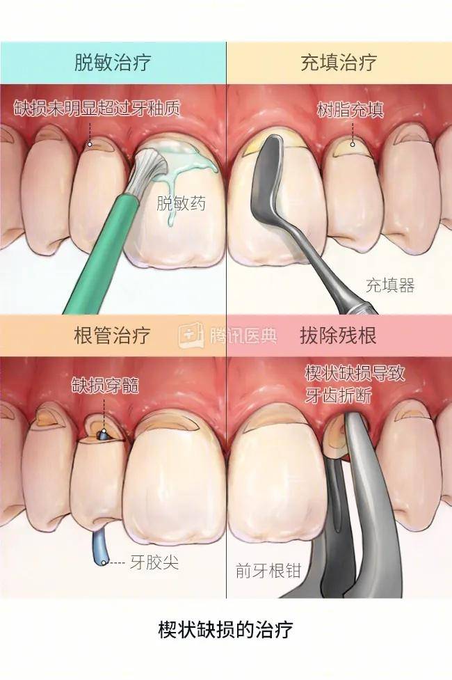 牙齿楔状缺损怎么治疗图片