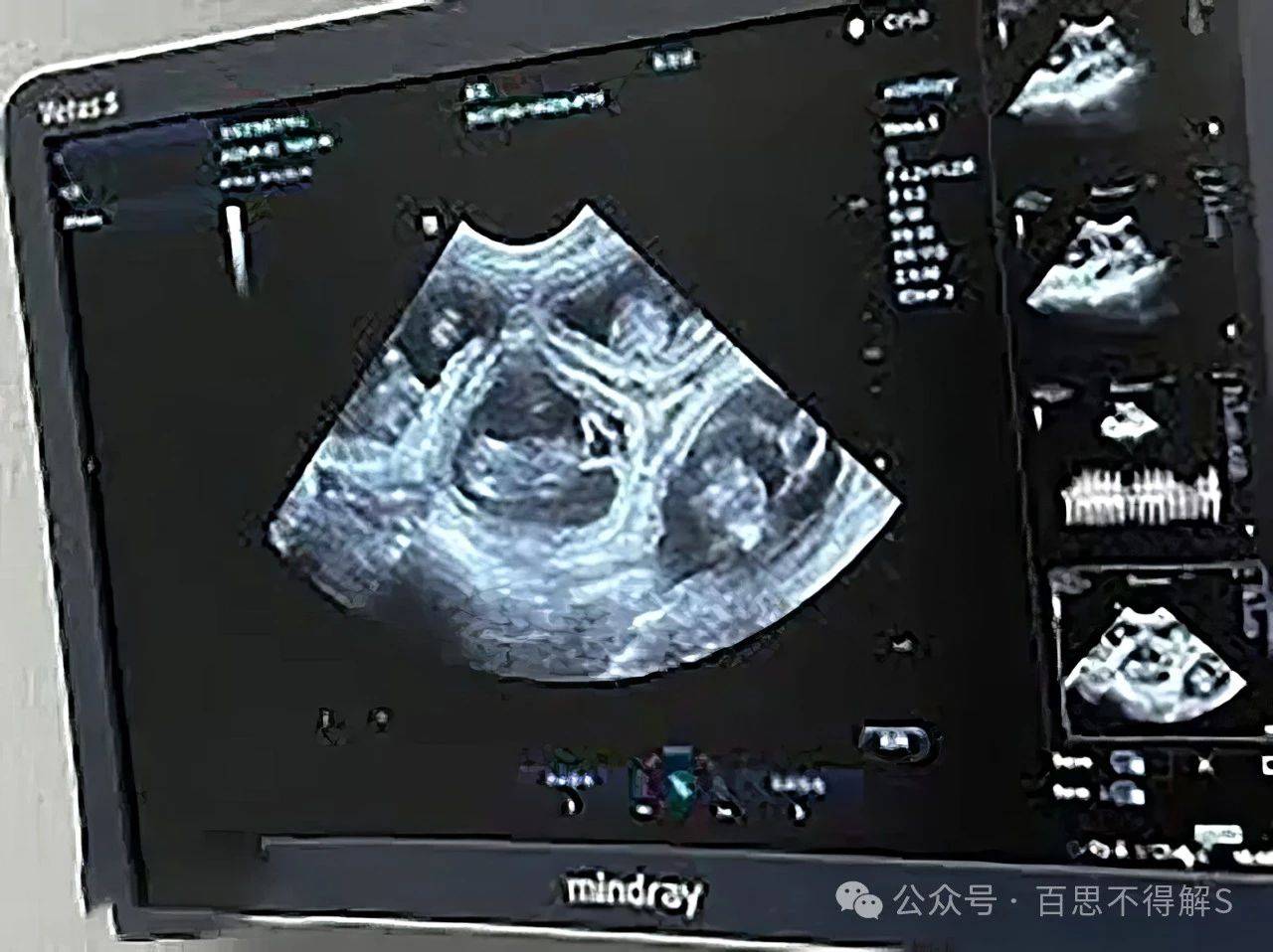 河北夫妻迎来五胞胎,背后却是无尽的艰辛与牺牲!