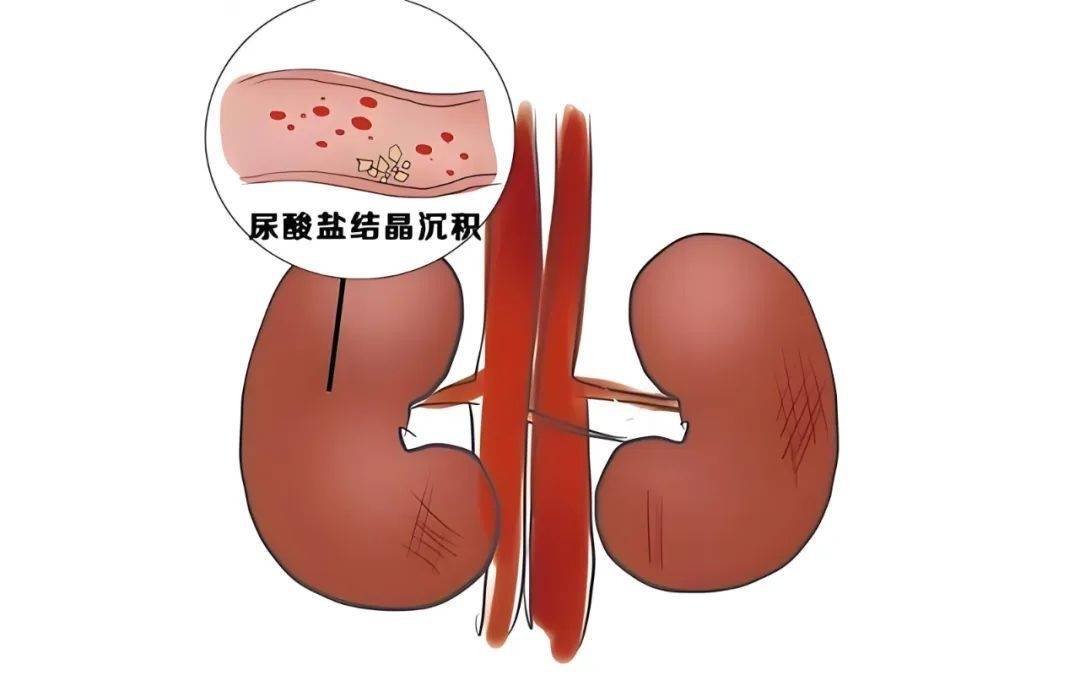 痛风肾超声表现图片