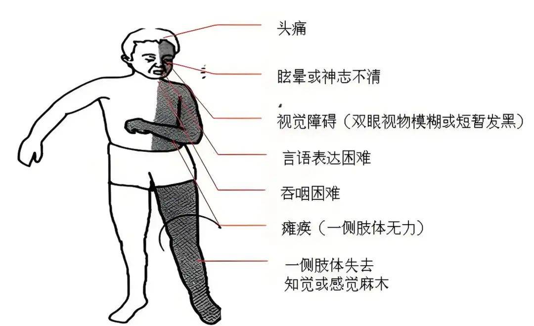 脑中风的危害巨大,患者可能会出现肢体瘫痪,言语障碍,认知功能障碍等