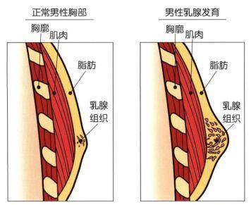 男性乳腺癌位置图图片