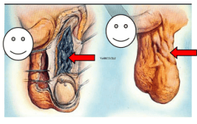 睾丸下降到阴囊的图片图片