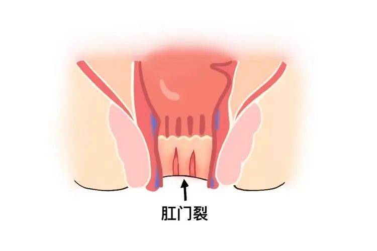 肛裂的症状正常图片