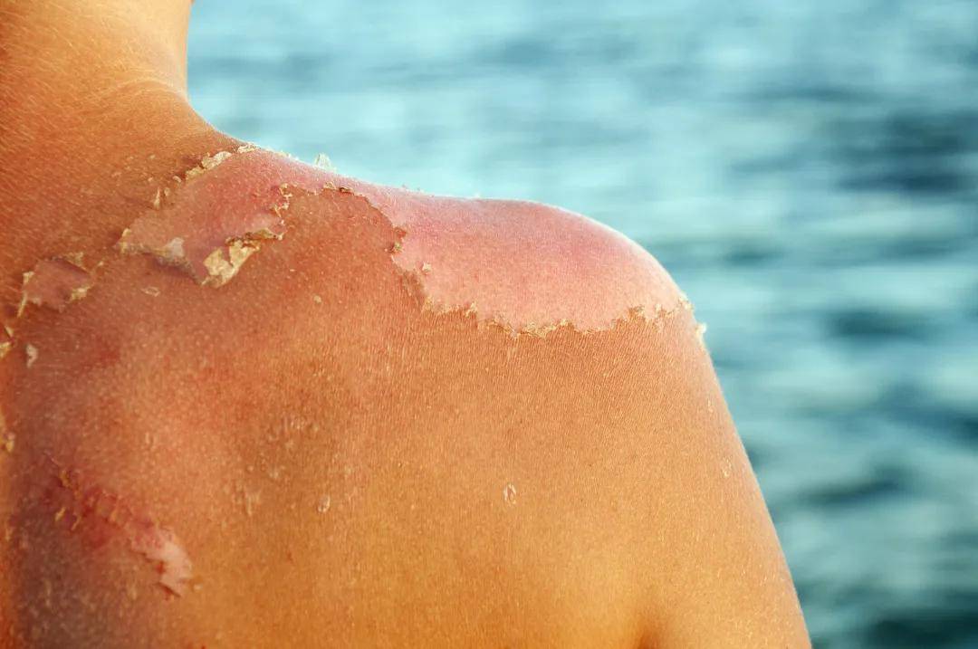 晒伤预防与处置