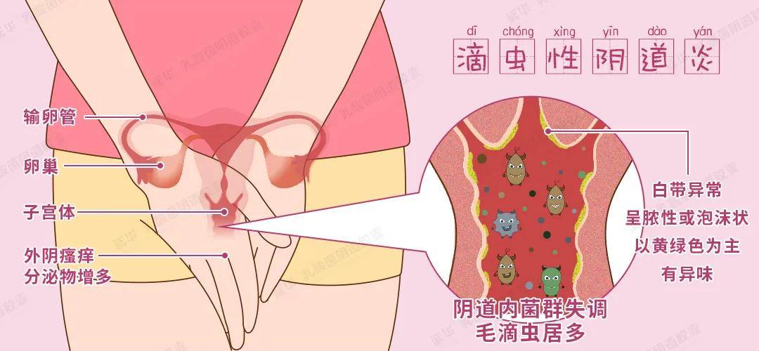 阴道微生态之生殖道感染滴虫性阴道炎