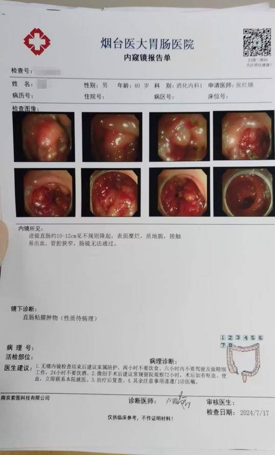 直肠腺癌早中晚期图片图片