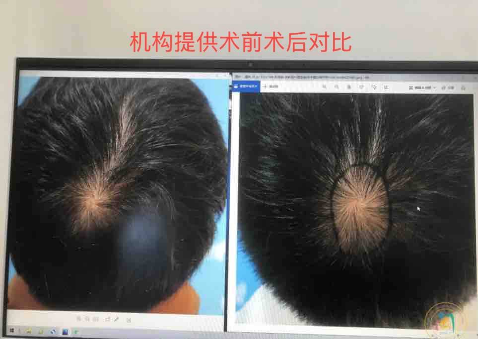 植发后不如不植?新京报曝雍禾医疗存活率五大保障履约难(图8)