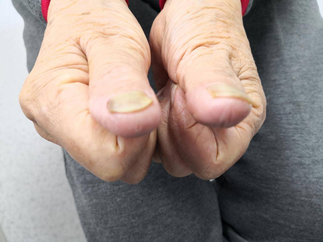 老年人指甲越厚,活的越久?看医生怎么说