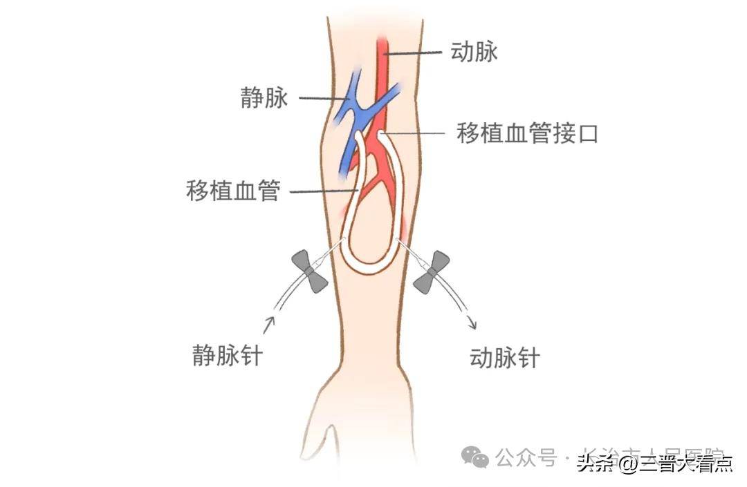 动静脉内瘘 卡通图片