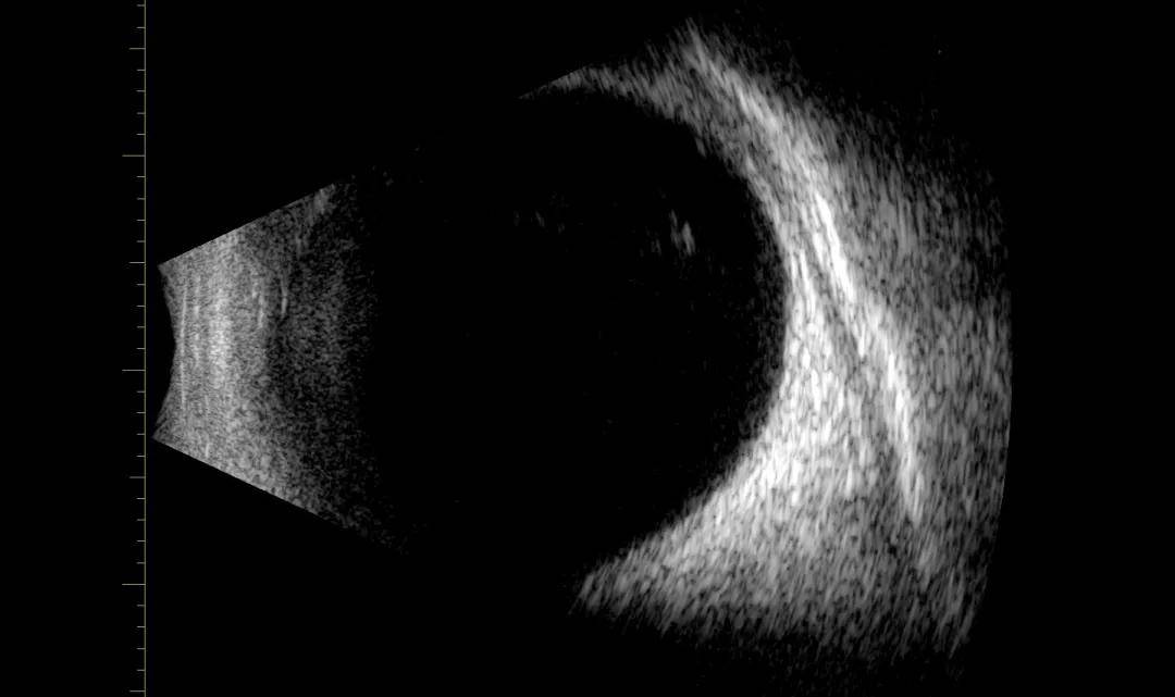 治疗_患者_玻璃体