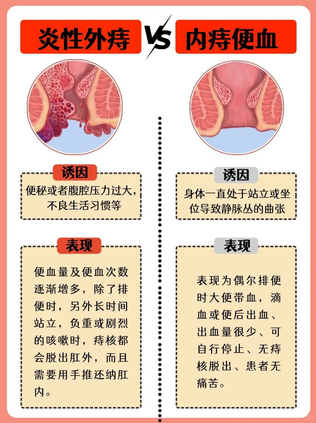 痔疮肉球最佳改善方法!