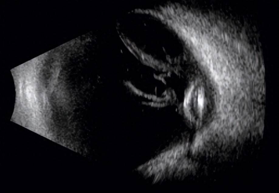 眼睛也可以做b超?带您了解关于"眼部b超"的那点事儿