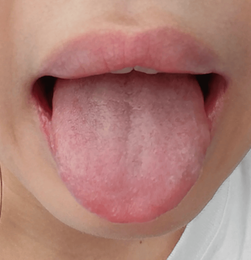 正常的舌头是淡红色到浅粉红色,如果身体气血不足颜色就会变白,变浅