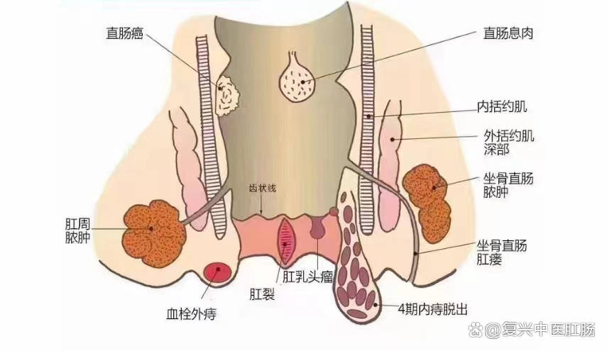 肛漏 原因图片