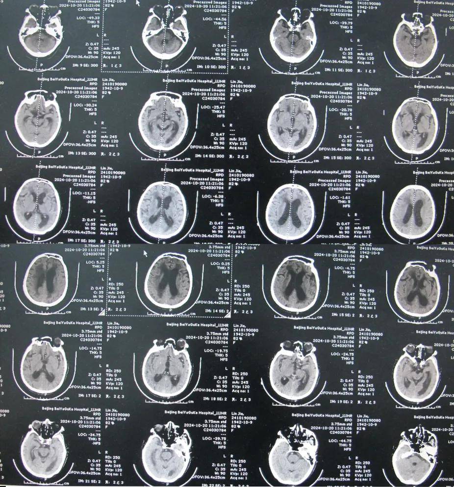 82岁脑出血后脑积水,北京某脑科医院治反致感染后19个月仍走路不稳