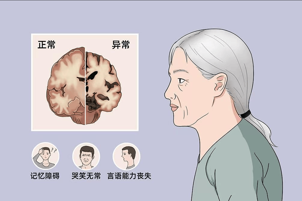 "老年痴呆"阿尔兹海默症 知识分享