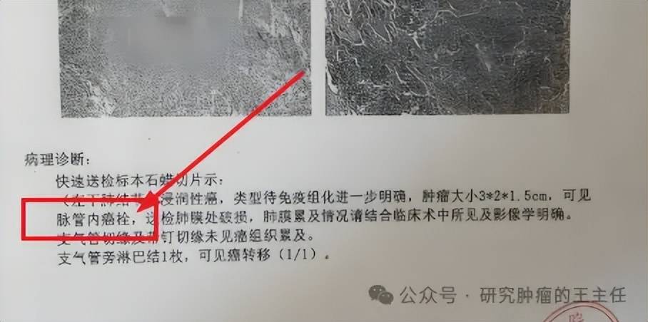 癌症患者病理报告中有这4点,病情恶化速度快,术后复发率很高!