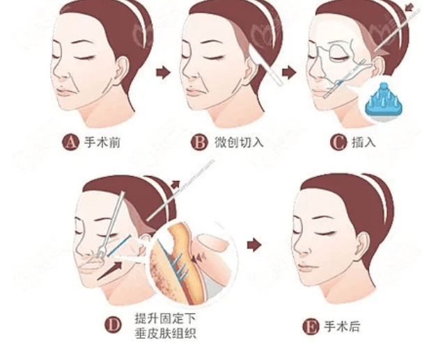 选择大于努力微拉美和线雕具体的区别在哪里,微拉美提升效果如何