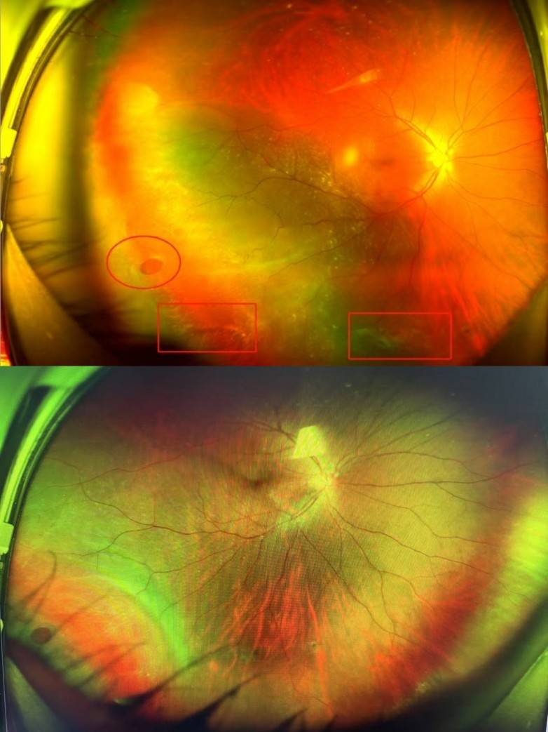 熬夜打游戏"网脱"险失明 医生用一招将脱离的视网膜"顶"回去