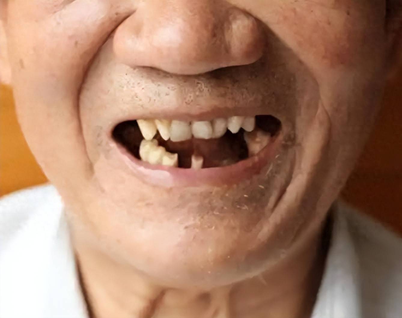 牙齿松动,咀嚼困难?不是老掉牙,而是骨骼对你发出的健康警告!