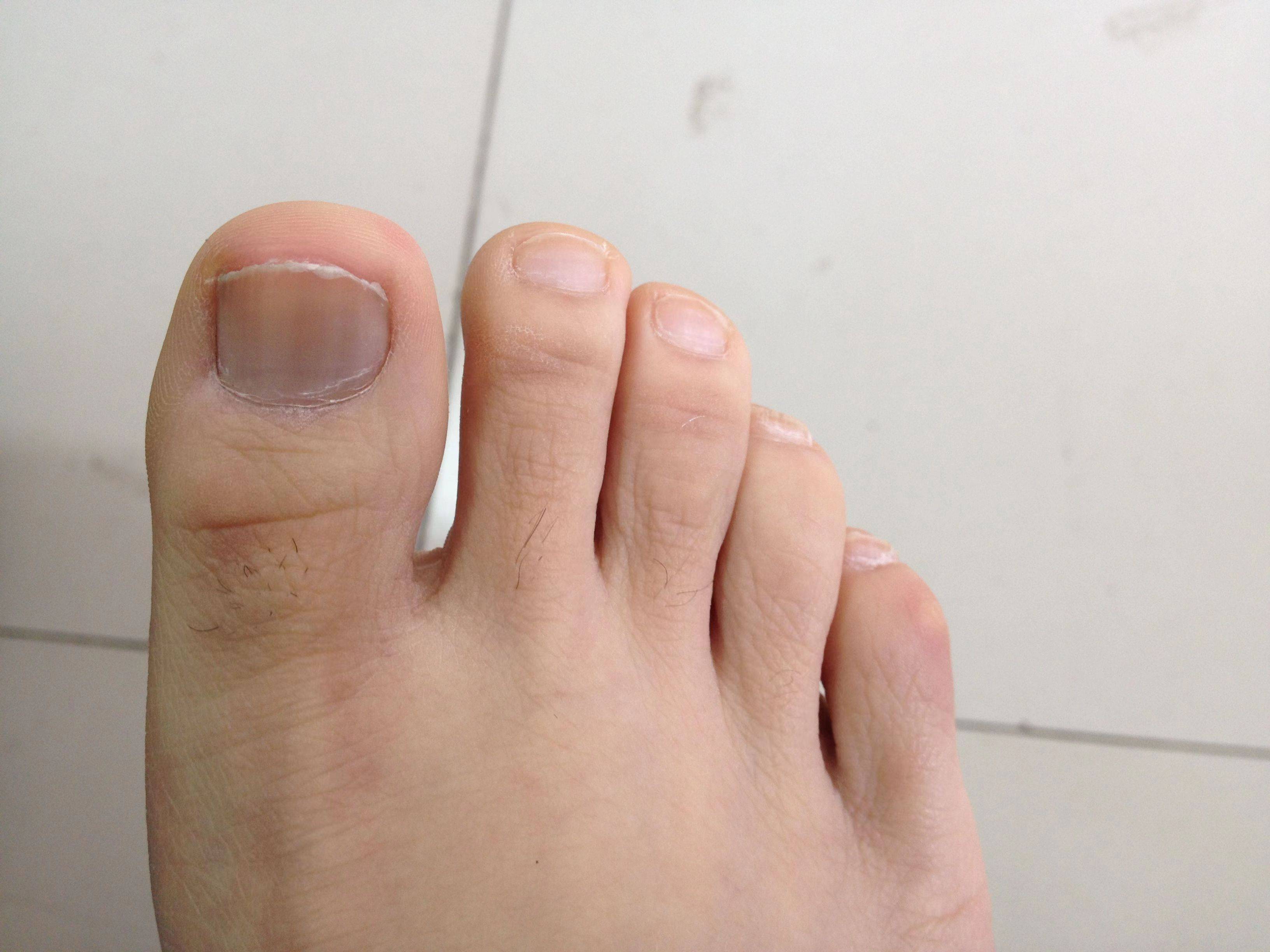 灰指甲断根方法竟然这么简单!28天轻松去除黄厚灰甲!