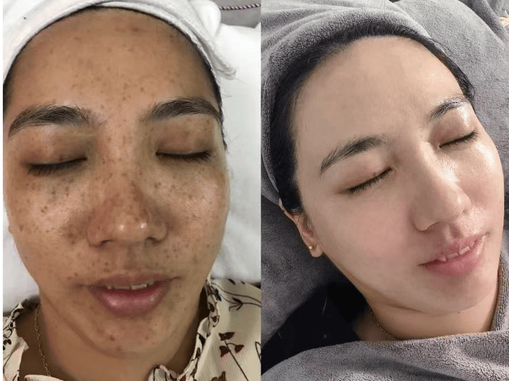 宝丽思曼真的能祛斑吗 宝丽思曼护肤品多少钱一套
