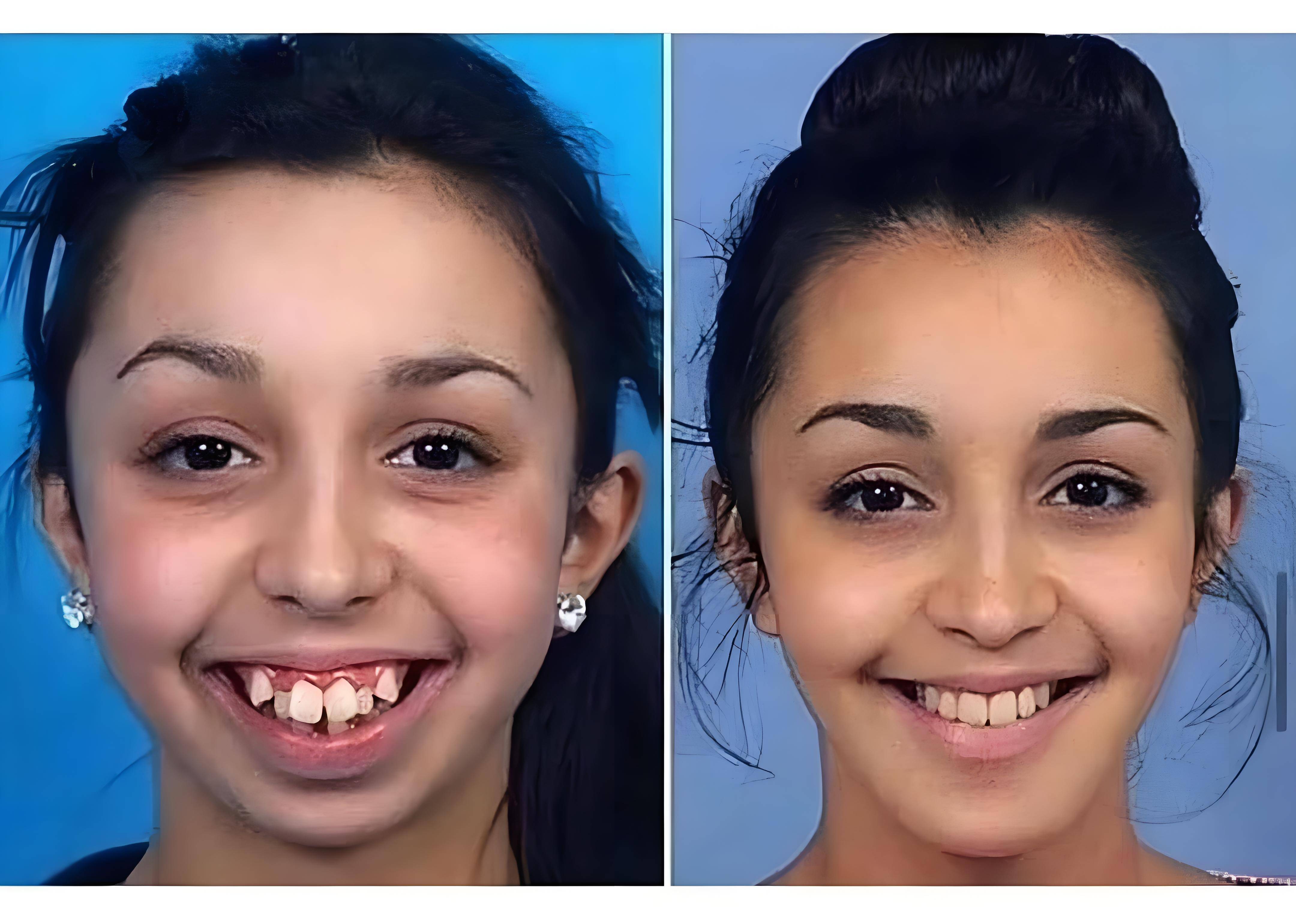 邢台牙齿矫正专家:早矫的意义是什么?