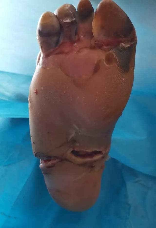 糖尿病足救治报道③:糖尿病足坏疽患者的日常管理与治疗配合