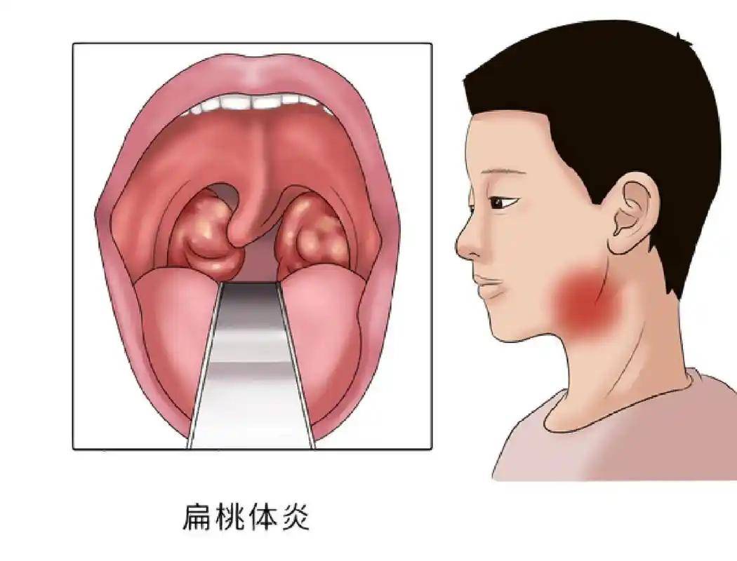当心扁桃体发炎找上门!
