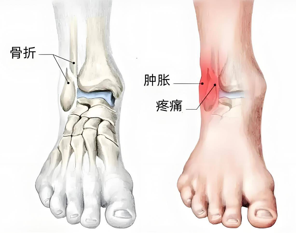 尤其是踝关节的创伤可能导致中长期出现创伤性关节炎,进而引发慢性