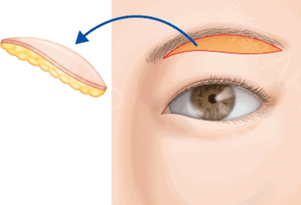 真相：提眉手术有风险和后遗症吗、提眉手术风险大吗（没想到）提眉手术效果好吗，