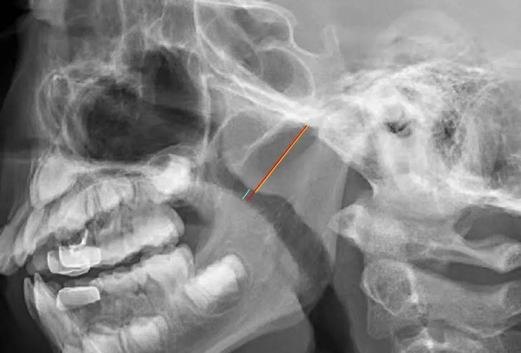 【高尚病例】腺样体肥大