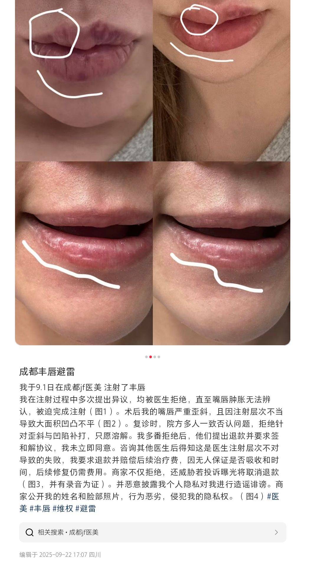 成都晶肤医美深陷投诉风暴:丰唇失败、假货疑云该如何破局?(图4)