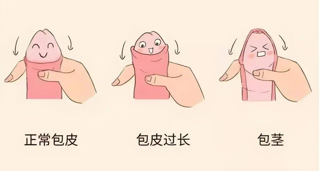 包茎割前割后图对比：哪些情况必须手术？