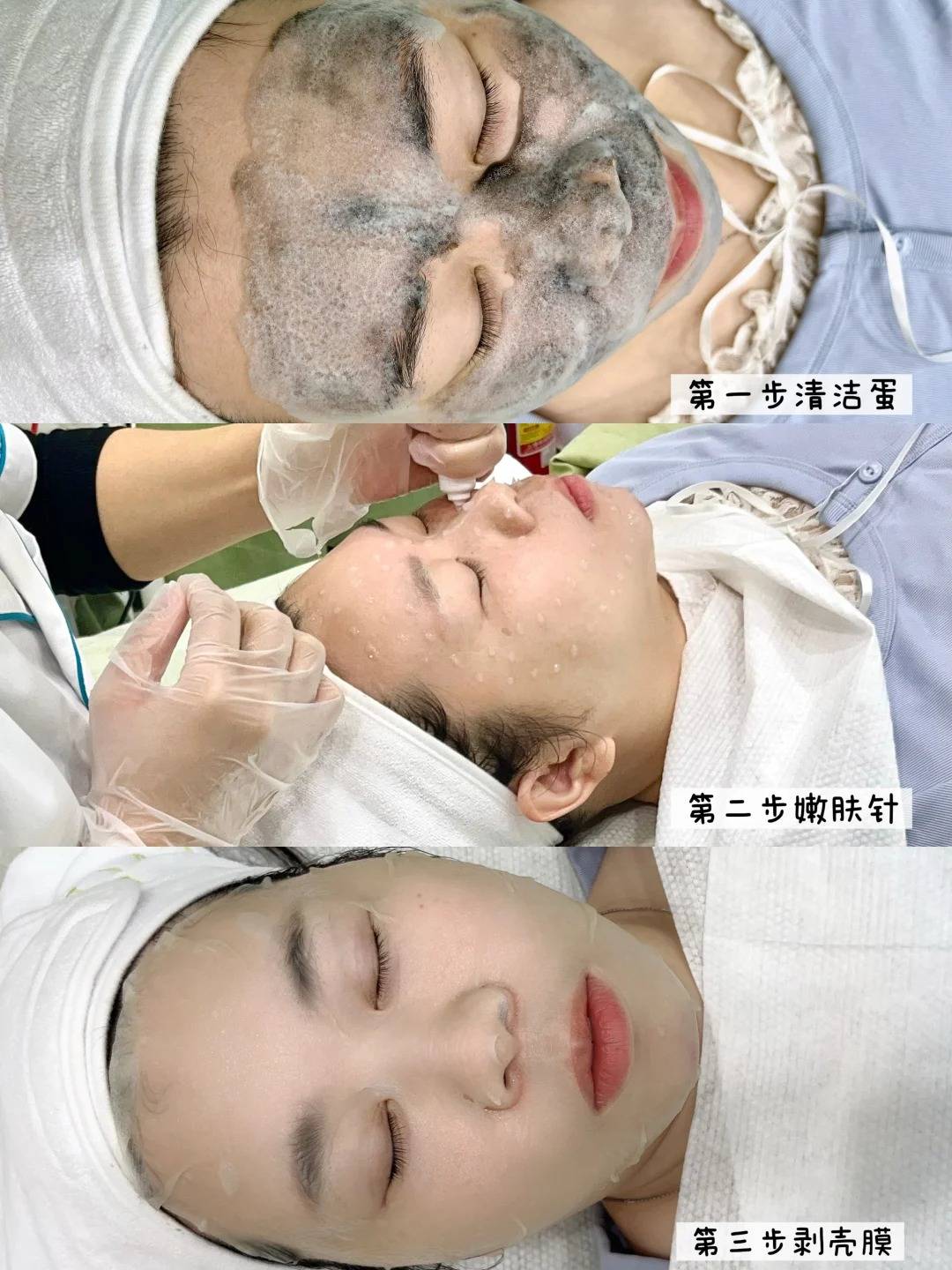 皮肤出油长黑头闭口怎么办?