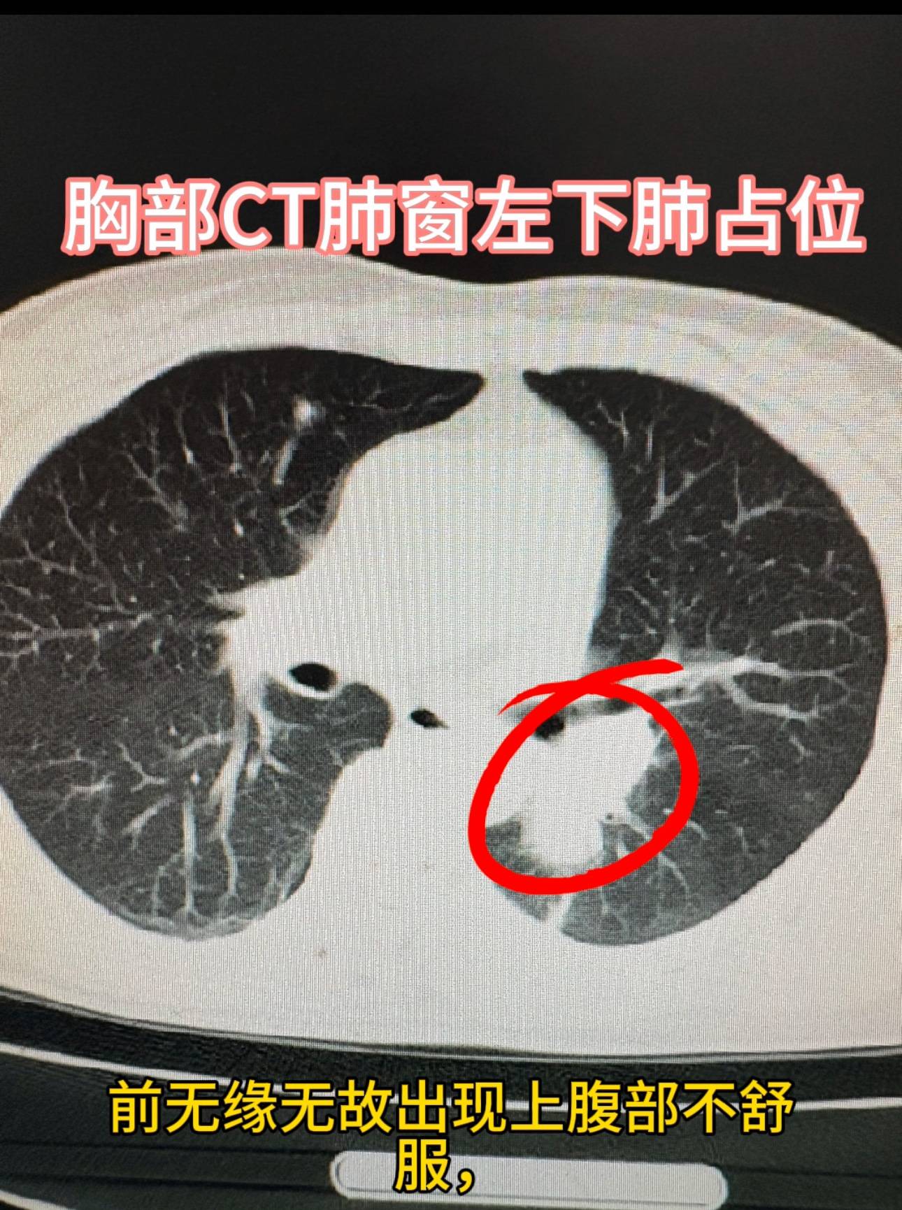 腹痛15天 以胆囊结石入院 竟查出肺癌晚期
