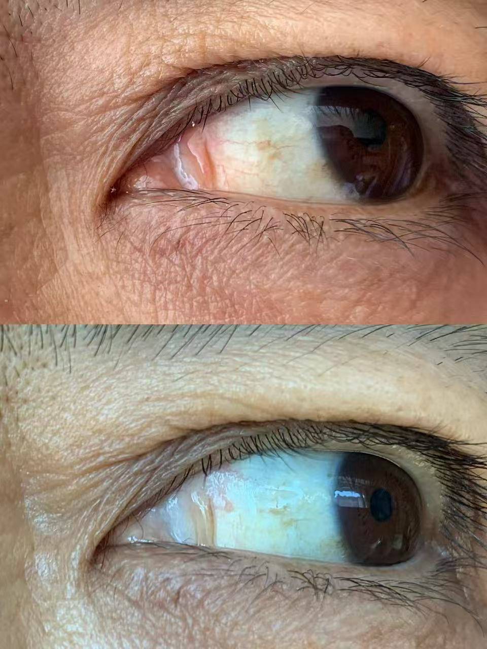 白眼球发黄发污怎么办?眼球抗衰