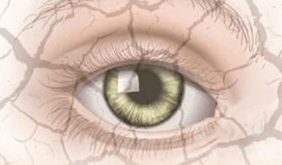 干眼症反复难愈？养血清肝为核心，2种中成药精准调理